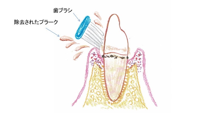 ブラッシング(歯磨き)