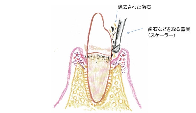 スケーリング・ルートプレーニング