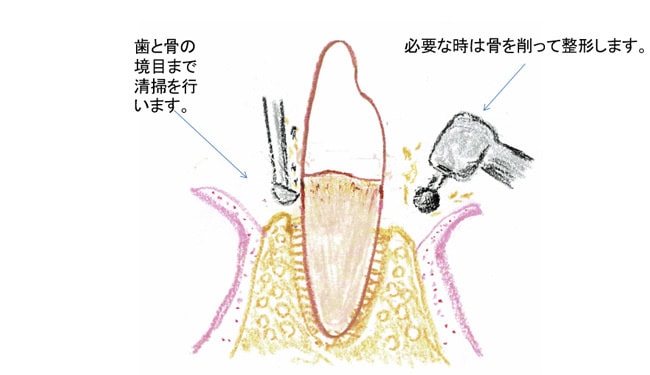 歯周外科(フラップ手術)