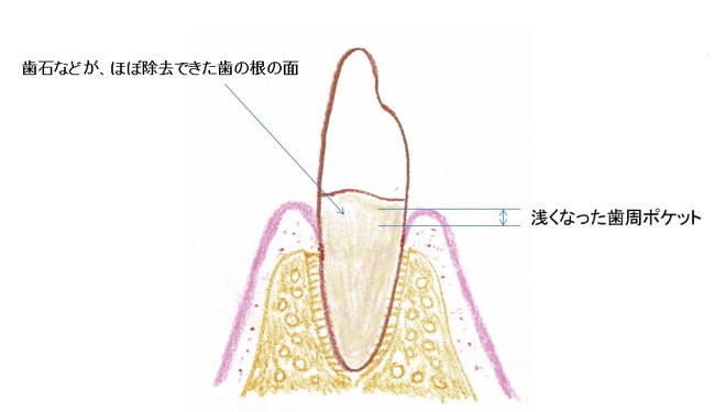 歯周治療後の治癒