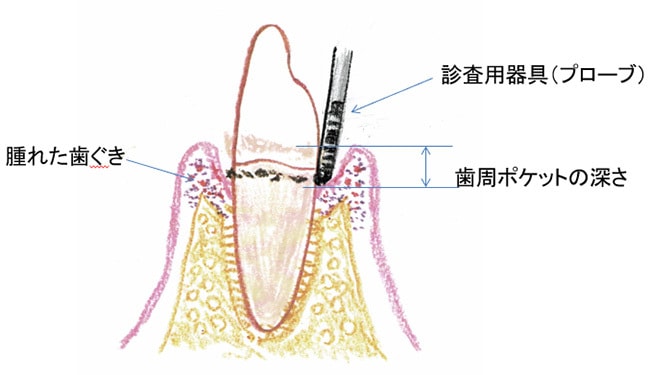プロービング（歯周ポケット測定）